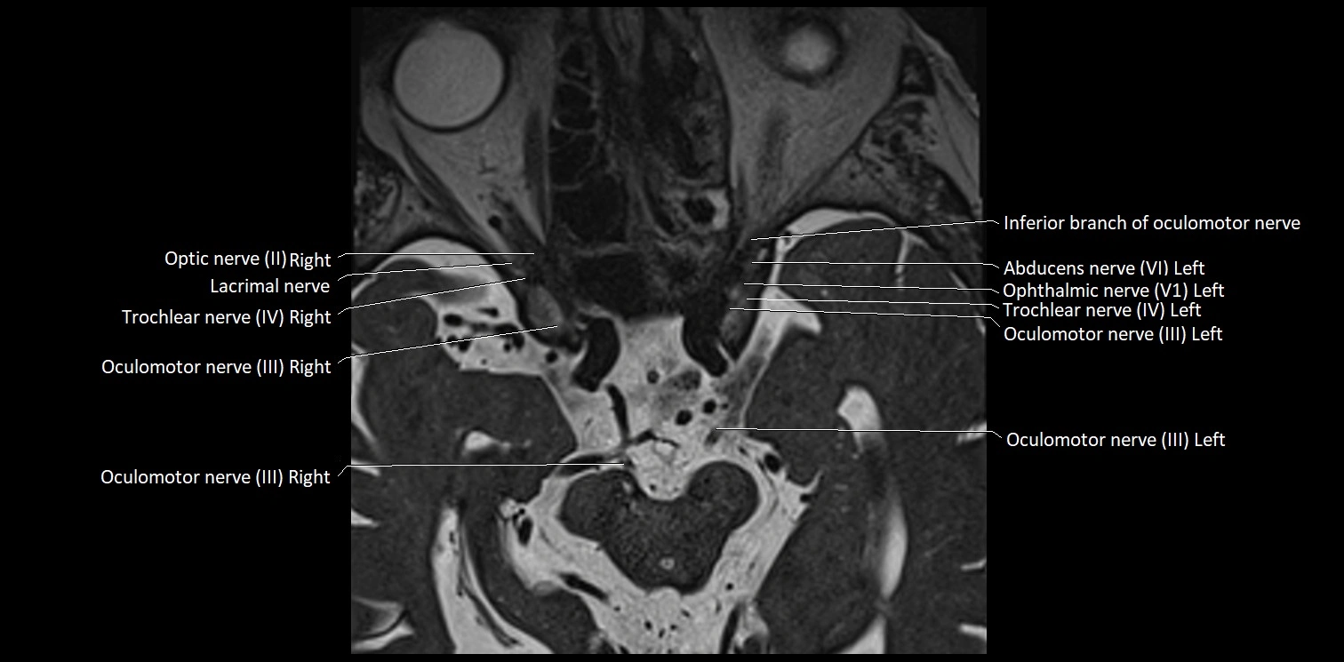Cranial nerve anatomy axial MRI 3T image 19.webp